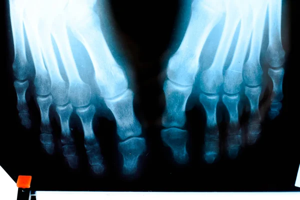Radiografia delle dita dei piedi. Piede sulla radiografia. ricerca ossea — Foto Stock