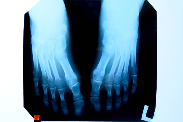 Рентгенівський знімок ніг. Ноги на рентгені. дослідження кісток — стокове фото