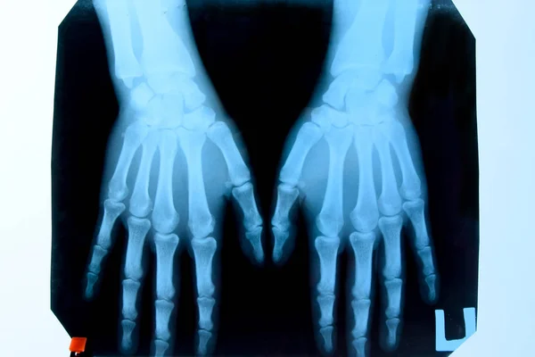 Ellerin röntgeni, x-ray'deki ellerin kemiklerinin resmi. — Stok fotoğraf