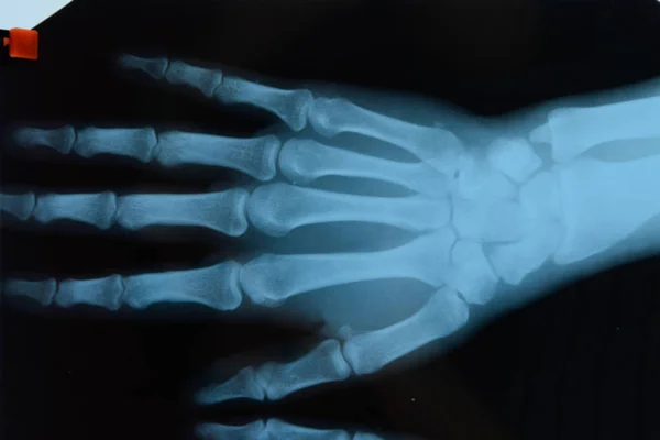 Ακτινογραφία των χεριών, μια εικόνα των οστών των χεριών στην ακτινογραφία. — Φωτογραφία Αρχείου