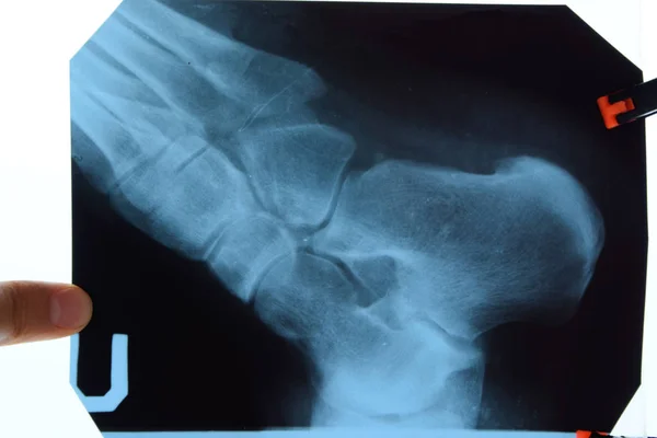 Ayak ve topuk kemiklerinin röntgeni. Kemiklerin X ışını resmi. — Stok fotoğraf