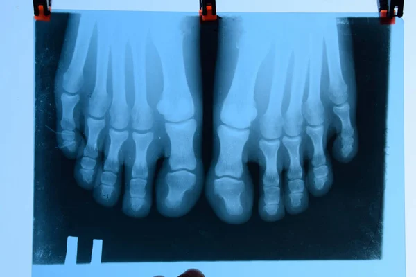 Rentgen prstů. Noha na XRAY. výzkum kostí — Stock fotografie