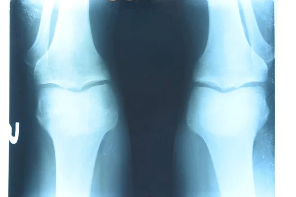 Xray of the knee joints, a picture of the bones of the knee on the x-ray. — Stock Photo, Image