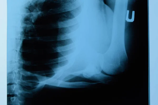 Raios-X de ombro e clavícula, imagem de raio-X da articulação do ombro . — Fotografia de Stock