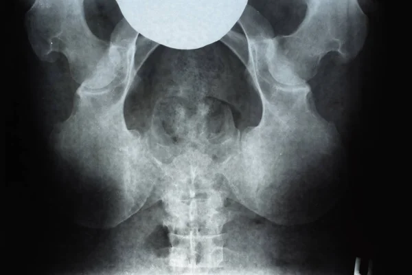 Radiographie du bassin et du sacrum. Radiographie — Photo