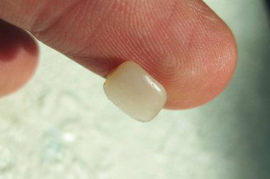 Yaşlı bir kesici ile doldurma düşmüş. Diş ve mühür.