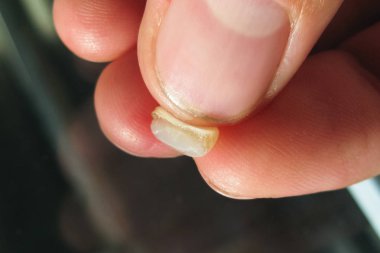 Yaşlı bir kesici ile doldurma düşmüş. Diş ve mühür.