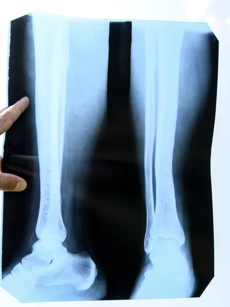 Ossa fuse della parte inferiore della gamba dopo aver rimosso la piastra di incollaggio in acciaio — Foto Stock