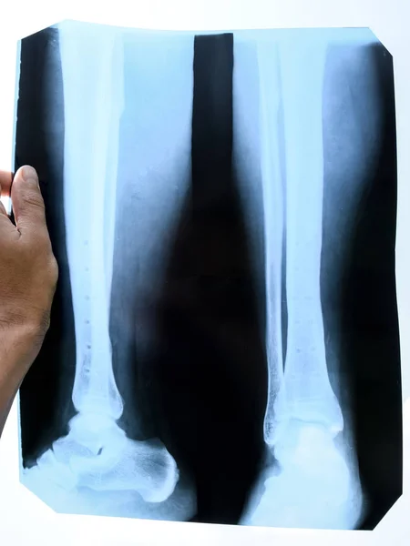 Smält ben i underbenet efter avlägsnande av stål bindnings plattan — Stockfoto