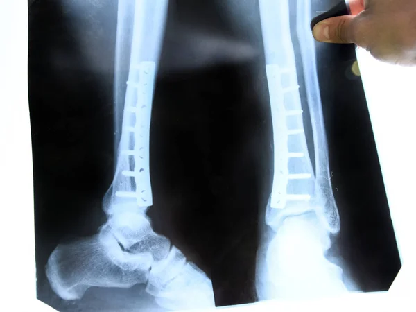 Steel plate holding together the tibia of the leg. — Stock Photo, Image