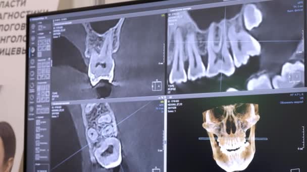 3D dental digitale modelleren restauratie. 3D-model van tanden, gescande tanden van de patiënt. De arts bestudeert de tand — Stockvideo