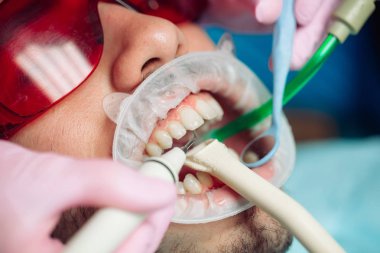 Profesyonel diş temizliği. Dişçi, erkek bir hastanın dişlerini temizler..