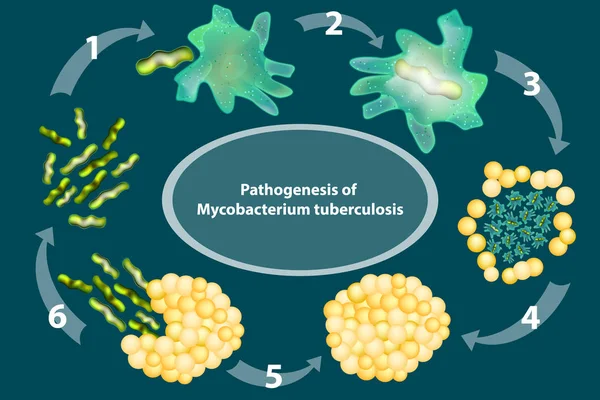 Patogenez Mycobacterium Tüberküloz Tüberküloz — Stok Vektör