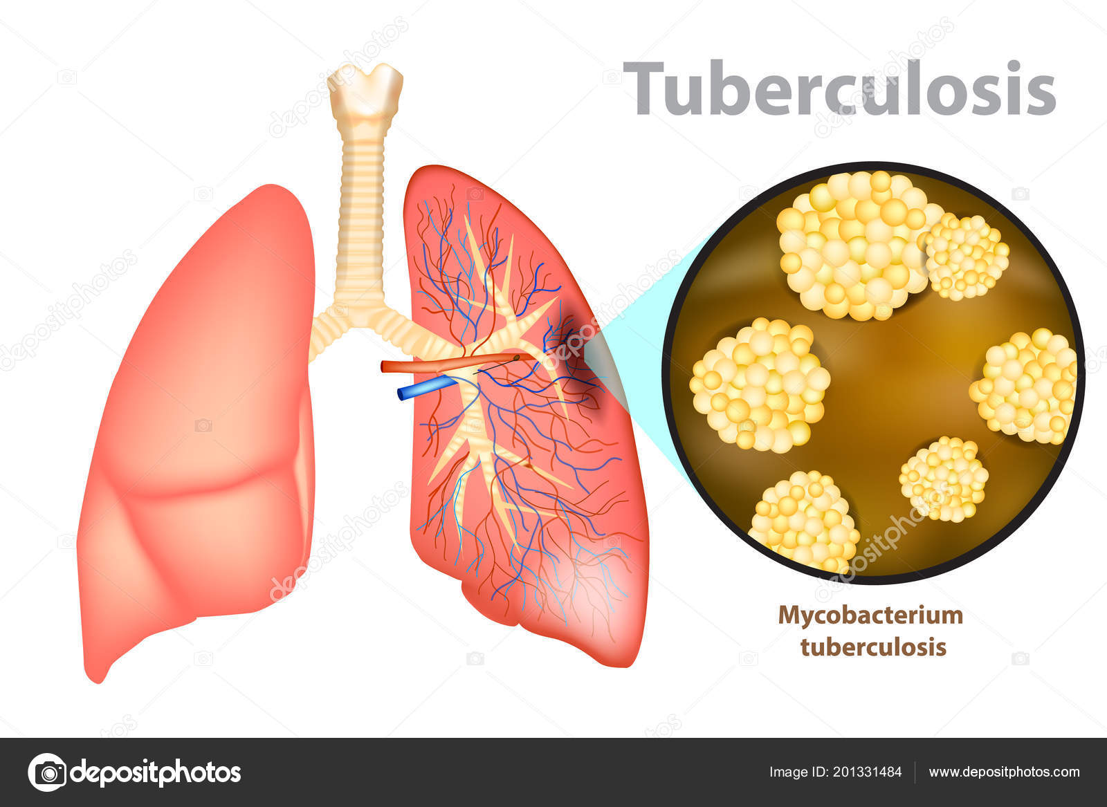 Tuberculosis A Infectious Disease