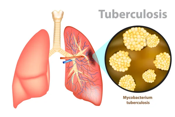 Туберкульоз Інфекційним Захворюванням Викликані Бактерією Туберкульозу Mycobacterium — стоковий вектор