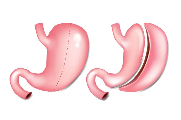 Gastrectomía Laparoscópica Manga Gástrica También Conocida Como Gastrectomía Curva Mayor — Archivo Imágenes Vectoriales