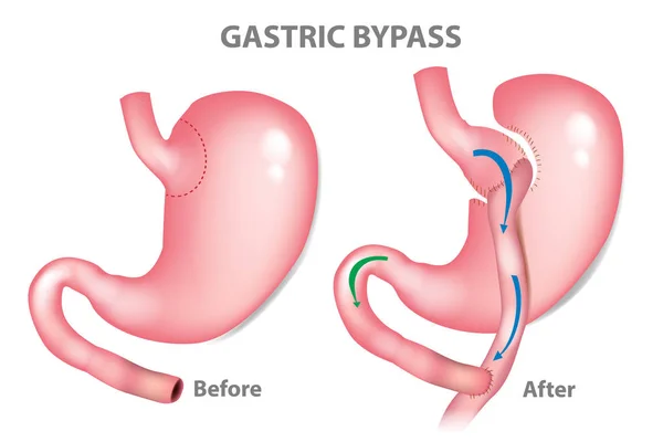 Cirurgia Bypass Gástrico Rny Roux Bypass Mini Gástico —  Vetores de Stock