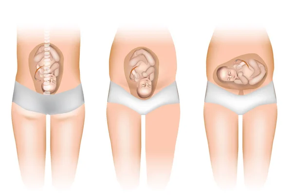 Těhotenství Různé Polohy Dítěte Děloze Postavení Plodu Děloze — Stockový vektor