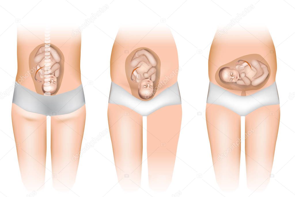 Pregnancy - Different Positions of Baby in the Womb. Fetus Positions In Uterus