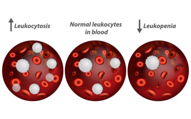 Leukocytosis and Leukopenia. White blood cell count.  clipart