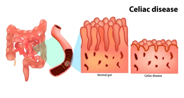 โรค Coeliac อโรค Celiac Enteropathy ไวต อกล เตน บางคร งเร — ภาพเวกเตอร์สต็อก