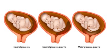 Farklı plasental mekanlar sırasında gebelik (büyük plasenta previa andnormal plasenta previa)