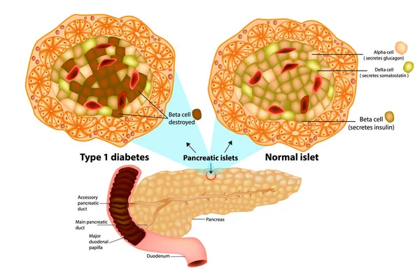 膵臓は インスリン産生 細胞とグルカゴン産生を含む多くの小島です タイプ 糖尿病 細胞破壊 — ストックベクタ