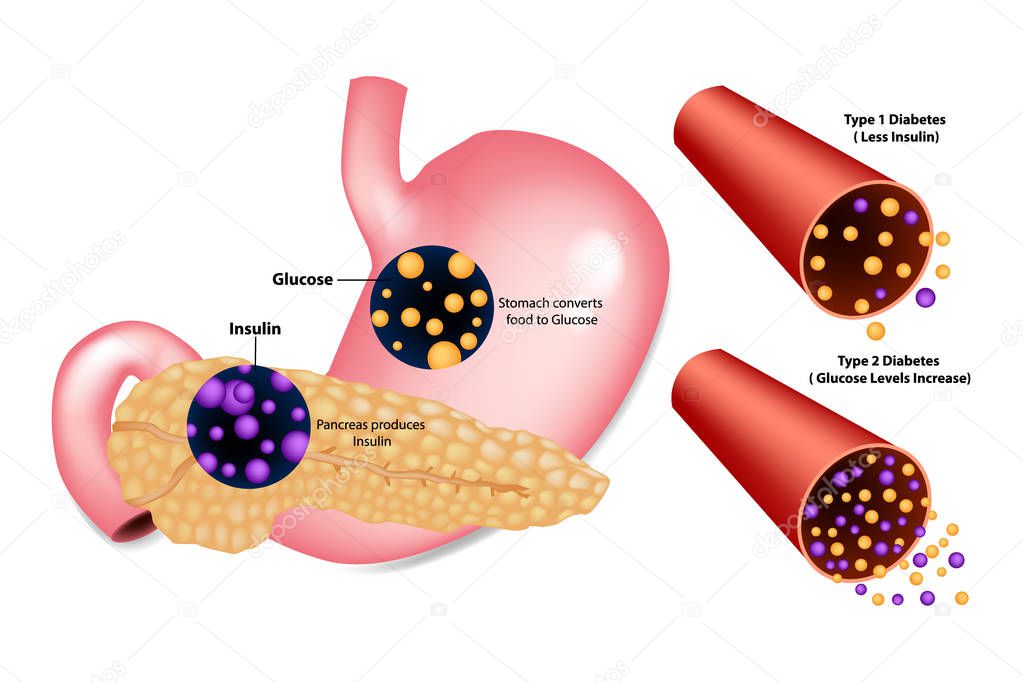 Diabetes Type 1( Less Insulin) and Type 2 (Glucose Levels Increase). Stomach converts food to Glucose. Pancreas produces Insulin.