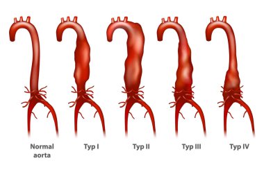 Abdominal aortic aneurysm (Thoracoabdominal). Crawford classification.  clipart