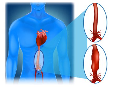 Abdominal aortic aneurysm - location and appearance.  clipart