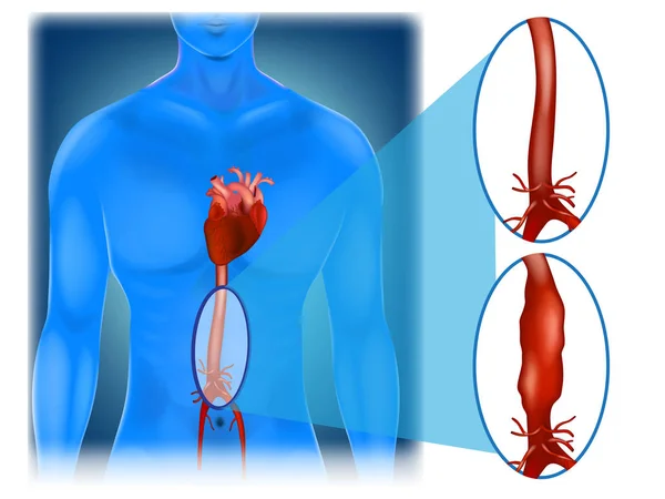 腹部大動脈瘤の場所と外観 — ストックベクタ