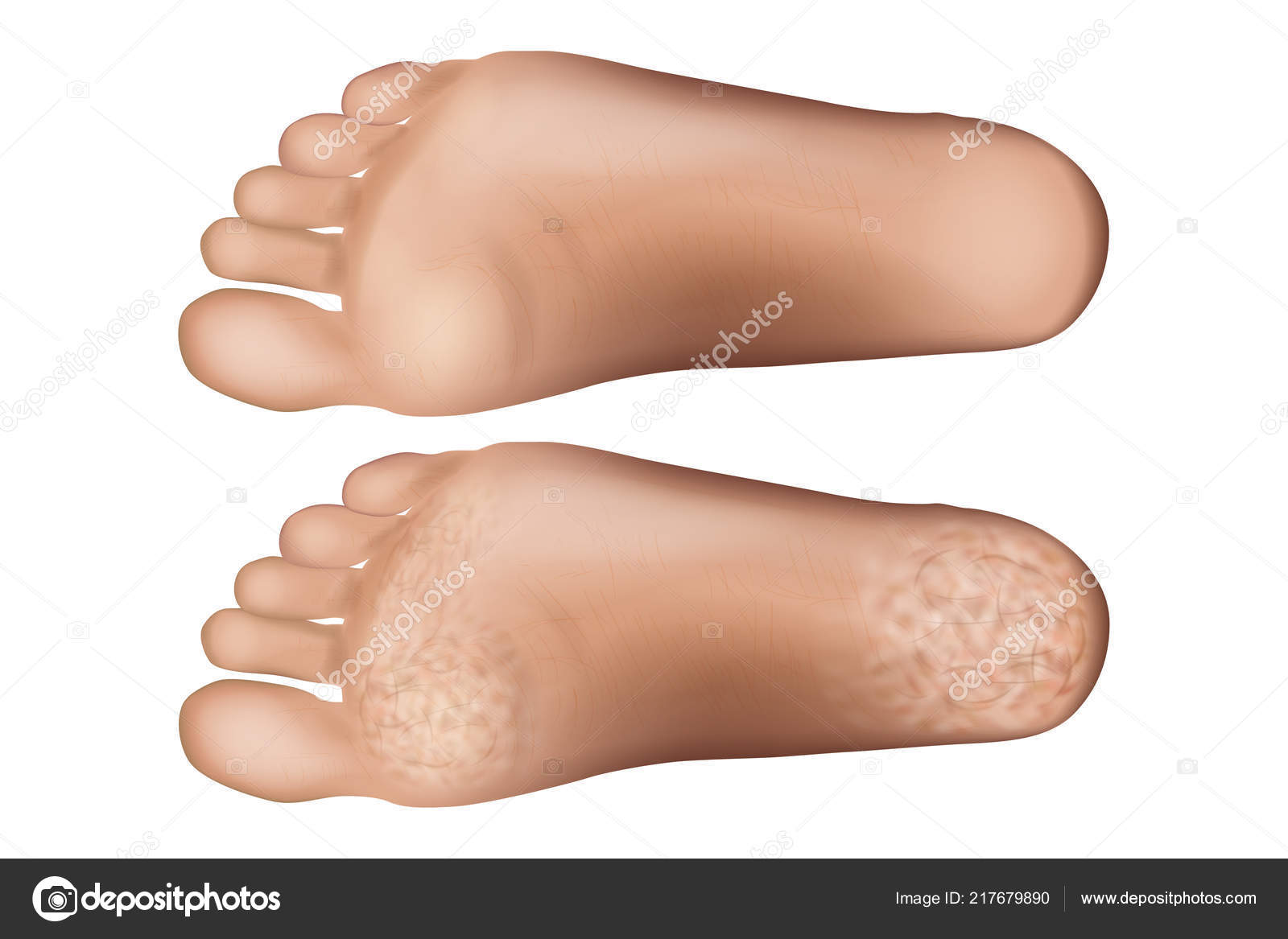 dry foot skin treatment