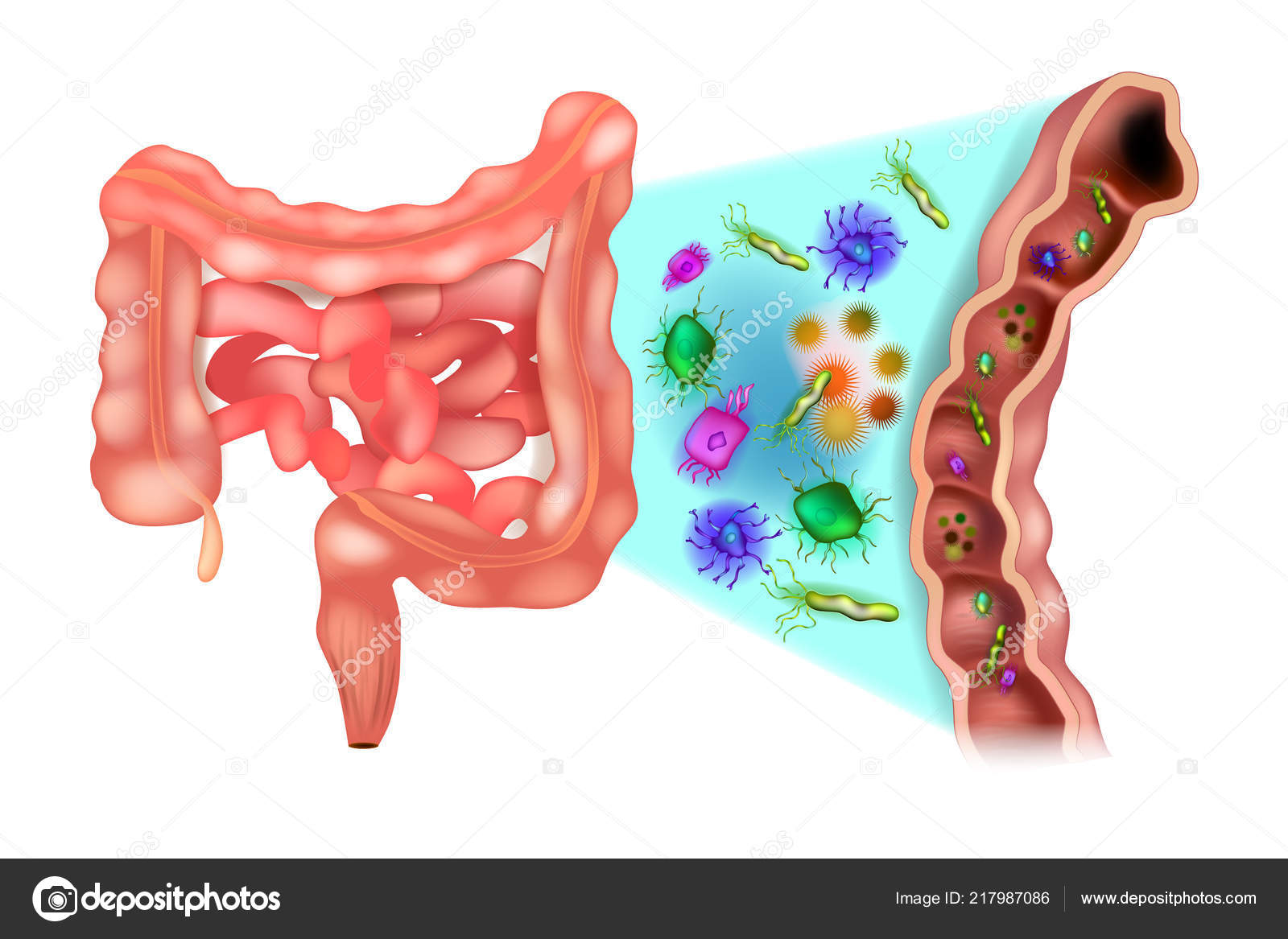 Dysbiosis colon - Diabetes type 2 dysbiosis.