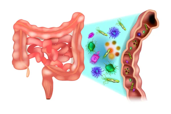 Dysbiose Également Appelée Dysbactériose Dysbactériose Intestin Bactéries Côlon — Image vectorielle