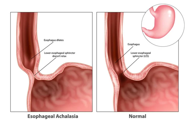 เอสโซฟาเท ปดาเล Esophageal Achalasia กเร ยกว ปดาเล ยธรรมดา นเนอร หลอดอาหารส — ภาพเวกเตอร์สต็อก