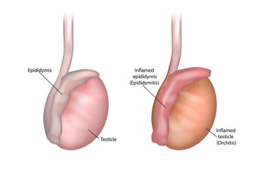 Testis ve epididim Illustration. Epididymitis (iltihaplı epididim) ve orşiti