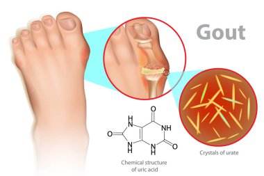 Illustration of foot with gout. Gout is a form of inflammatory arthritis is due to persistently elevated levels of uric acid in the blood. clipart