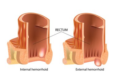 İç ve dış hemoroid gösteren tıbbi çizim. Hemoroid türleri. Hemoroid, hemoroid, olarak da bilinir anal kanal vasküler yapılardır.