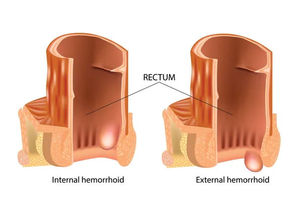 Ilustración Médica Mostrando Hemorroides Internas Externas Tipos Hemorroides Las Hemorroides — Archivo Imágenes Vectoriales