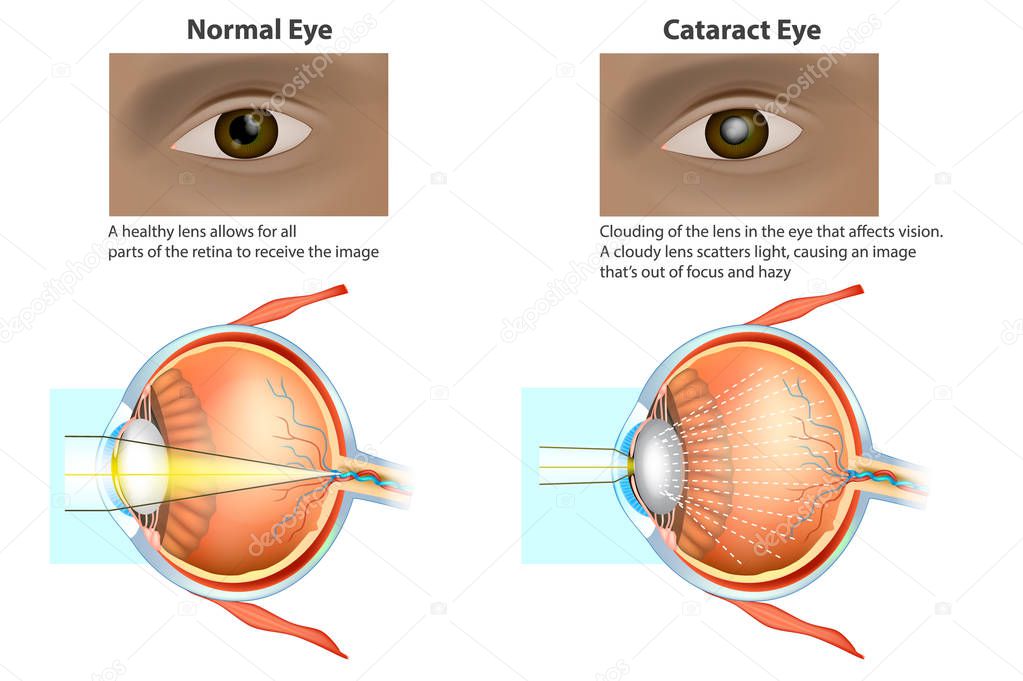 ataract is a clouding of the lens. Medical illustration of a normal eye and an eye with a cataract, clouded lens