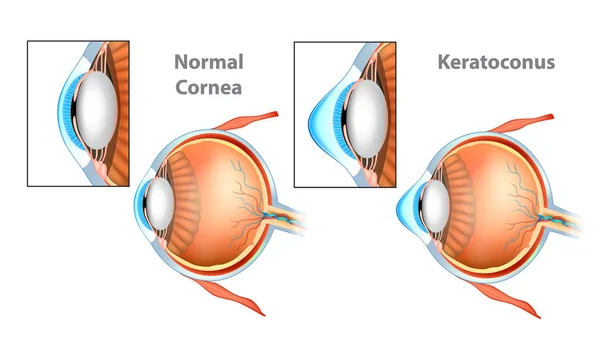 通常角膜 角膜角膜 — ストックベクタ