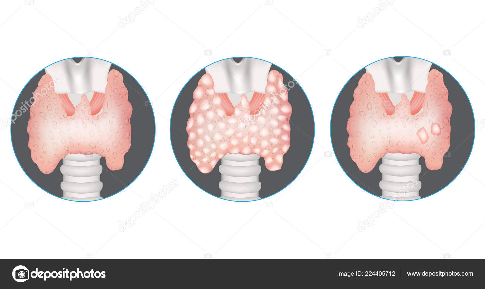 Multinodular goiter