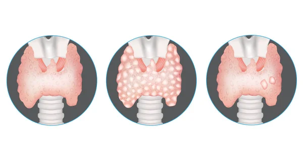 Penyakit Kelenjar Tiroid Tiroid Sehat Goiter Multinodular Dan Kelenjar Dengan - Stok Vektor