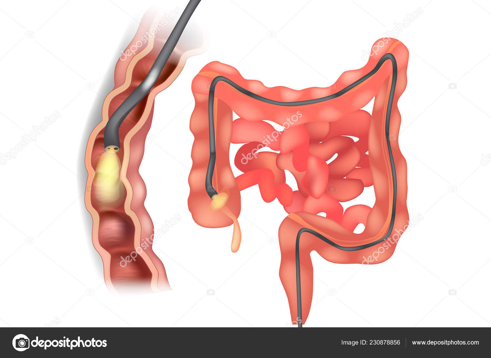 Illustration Colonoscope Colon Colonoscopy Procedure Endoscopy Stock Vector by ©Sakurra 230878856