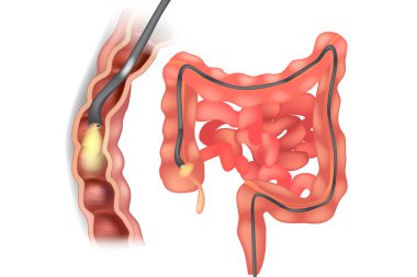 Illustration of colonoscope in the colon during a colonoscopy procedure. GI Endoscopy  clipart