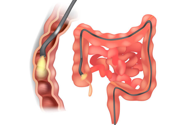 Illustration of colonoscope in the colon during a colonoscopy procedure. GI Endoscopy 