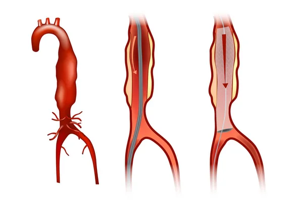 Endovasculaire Aneurysma Reparatie Endovasculair Aorta Reparatie Evar — Stockvector