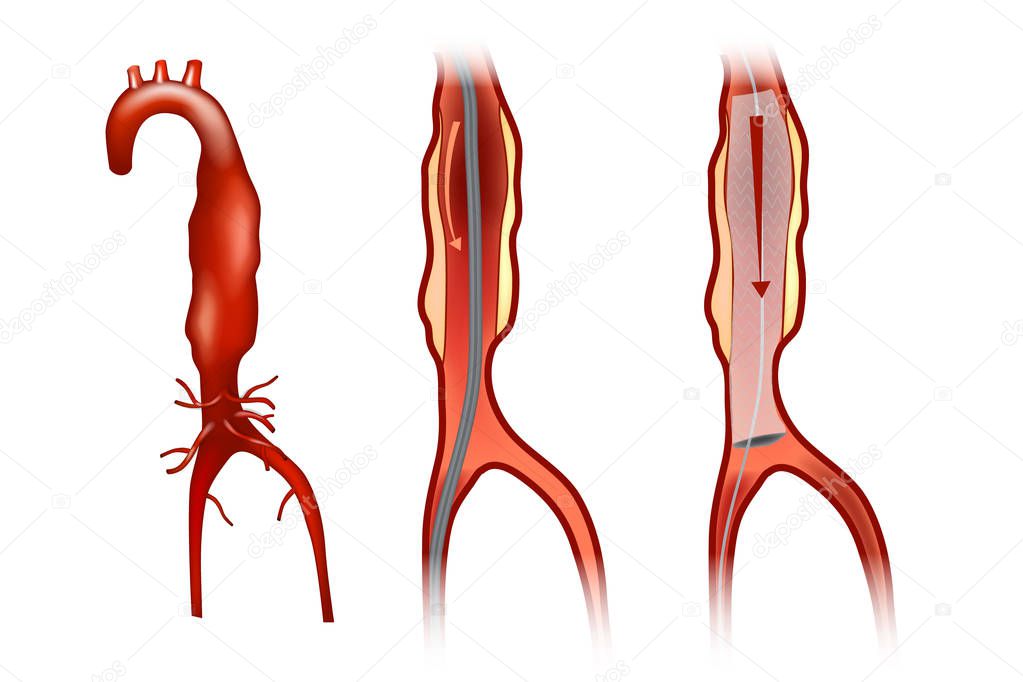 Endovascular aneurysm repair (or endovascular aortic repair) (EVAR)