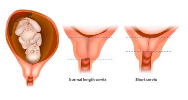 Normal length cervix and short cervix in Pregnancy. The cervix or cervix uteri clipart