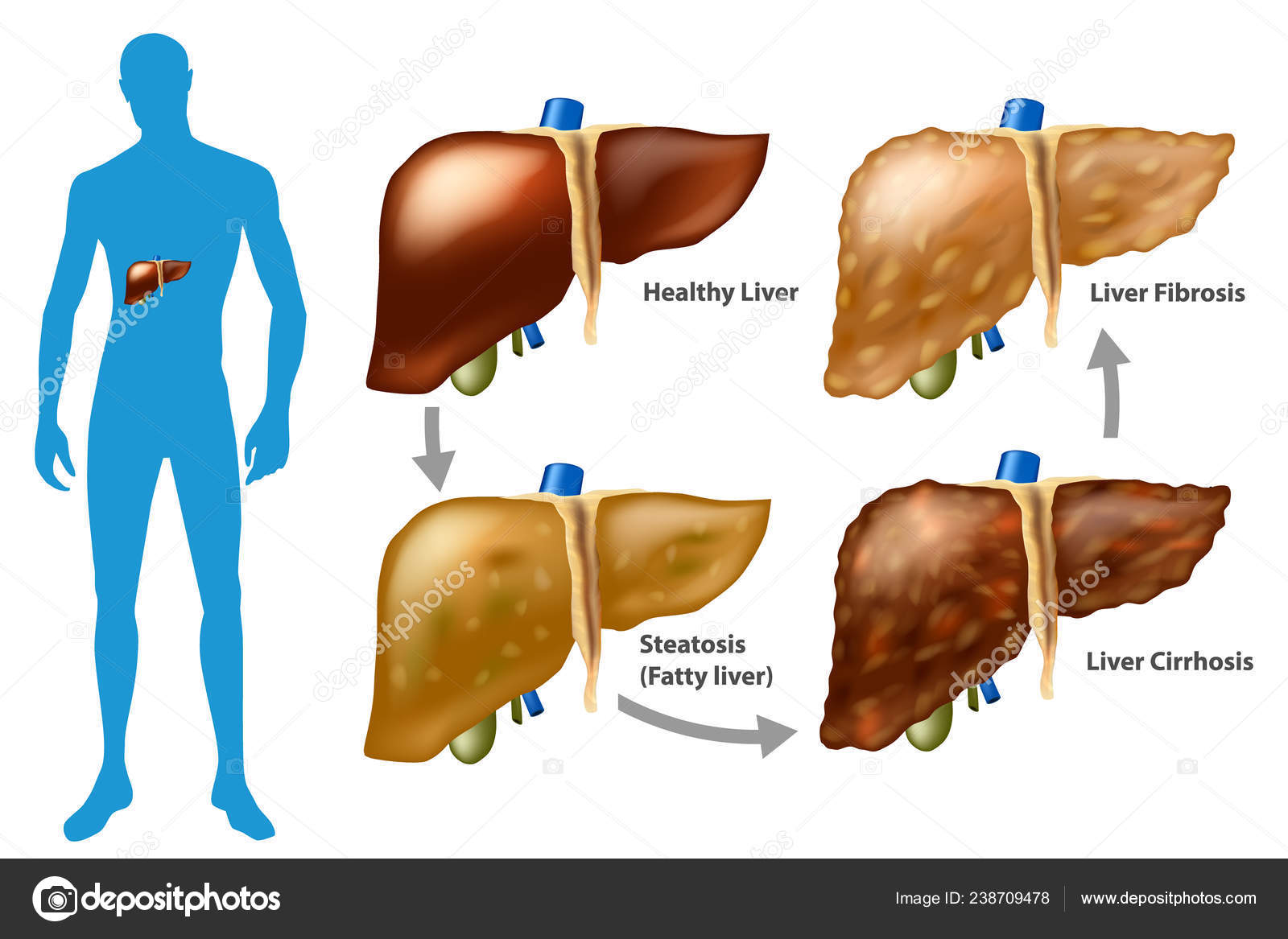 ©Sakurra　ストックベクター　—　線維症　肝硬変　肝臓病の進行　肝臓の損傷のステージ　238709478
